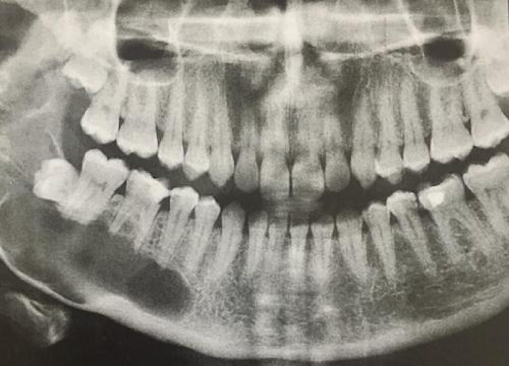 odontogenic keratocyst, example of integrated learning